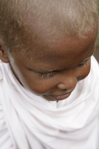 image Pelo rubio síntoma de malnutrición, hospital de Gambo, Etiopía