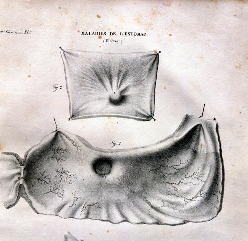 image Enfermedades del estómago