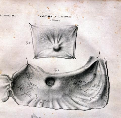 image Enfermedades del estómago