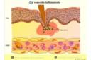 Reacción inflamatoria y formación del pus