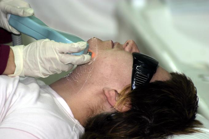 image Fotodepilación: encendido del electrodo